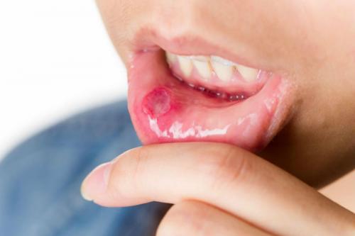Налет на языке у взрослых. Грибковые, вирусные и бактериальные инфекции